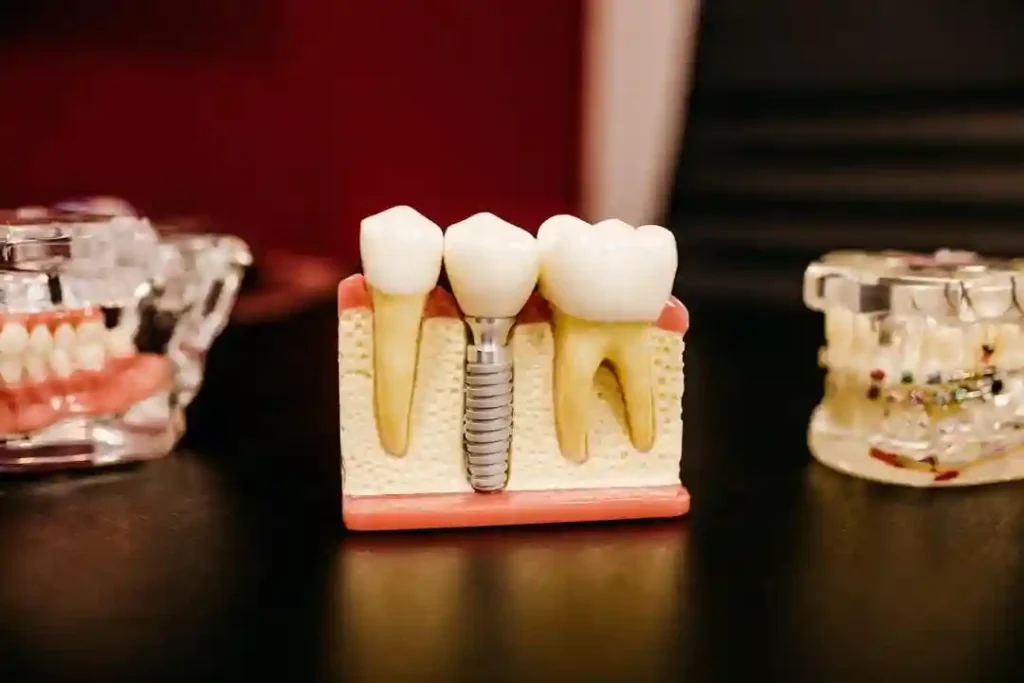 Exploring the Factors that Affect All-on-4 Dental Implants Cost