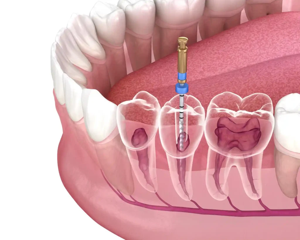 Root canal treatment in Wilmington