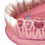 Root canal treatment in Wilmington